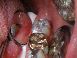 Frisch gelegte u. brünierte Amalgamfüllung